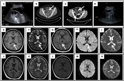 Case report: Autoimmune encephalitis with multiple auto-antibodies with reversible splenial lesion syndrome and bilateral ovarian teratoma